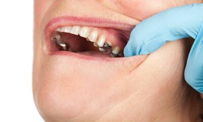how to heal cavities in 2 days at home
