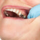how to heal cavities in 2 days at home