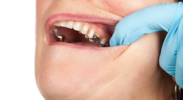 how to heal cavities in 2 days at home